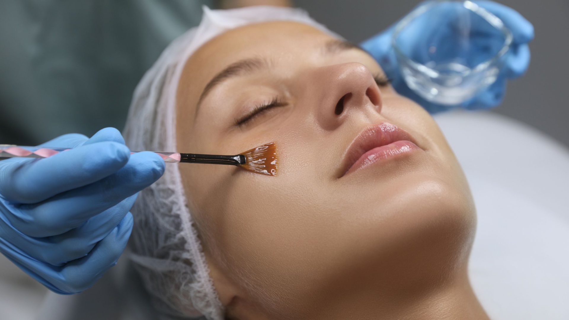 Types of Chemical Peels in Cosmetology